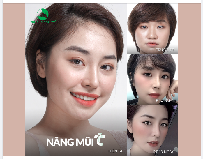 Chỉ với 15 phút thực hiện - Khắc phục tình trạng mũi thấp, cánh mũi to bè