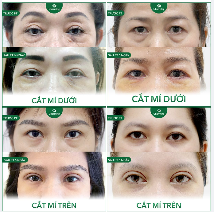Một vài hình ảnh Cắt mí mắt tại Thẩm mỹ viện Charming tập hợp lại cho Khách hàng dễ tham khảo hơn nhé!