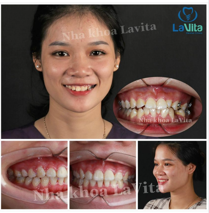 NGOÀI 30 TUỔI CÓ THỂ NIỀNG RĂNG ĐƯỢC NỮA HAY KHÔNG?