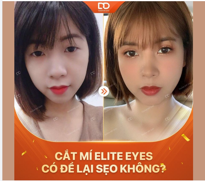 CẮT MÍ ELITE EYES CÓ ĐỂ LẠI SẸO KHÔNG?