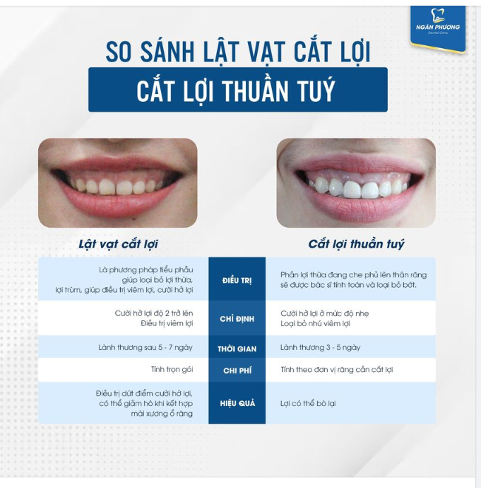 Cười hở lợi không còn là nỗi lo nhưng chọn đúng phương pháp mới giữ được nụ cười tươi mãi chẳng phai bạn nhé