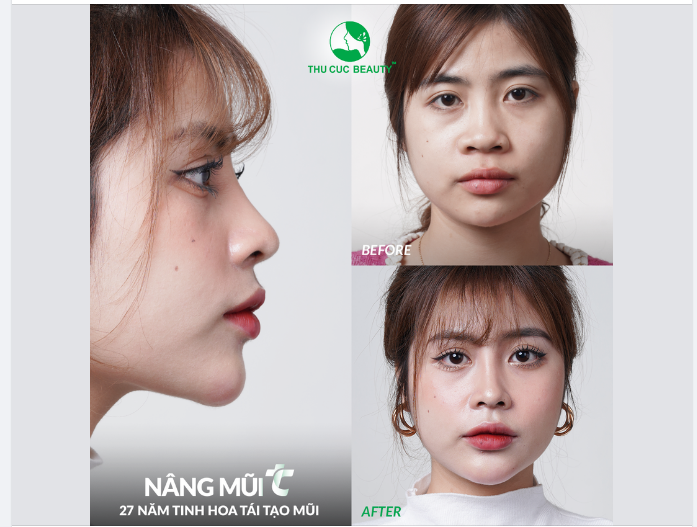 Hot girl Linh Phi xinh đẹp, tỏa sáng chỉ sau 15 phút nâng mũi TC