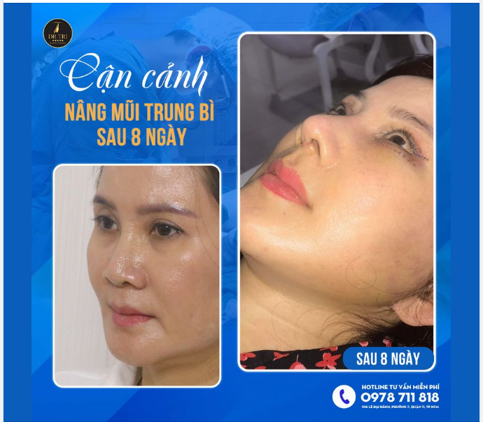 GÓC NGHIÊNG ĐỈNH CAO NHỜ NÂNG MŨI TRUNG BÌ