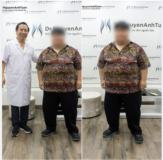 Bệnh nhân cao 1m60 nặng 140kg chỉ số BMI 54,7 (mức độ béo phì trầm trọng) một trường hợp mắc bệnh béo phì thực sự ấn tượng.