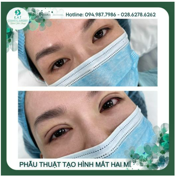 Khi nào bạn nên phẫu thuật nhấn mí.