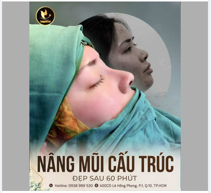 NÂNG MŨI CẤU TRÚC – ĐẸP SAU 60 PHÚT