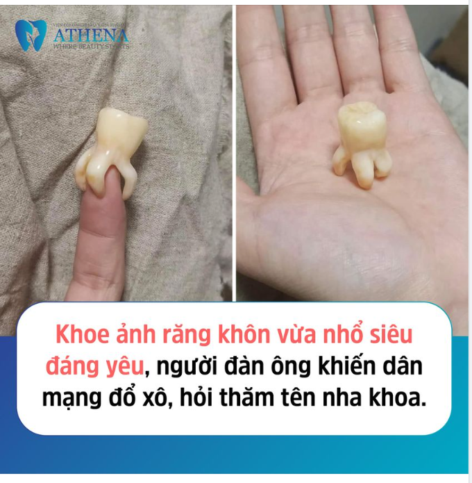 BẠN CÓ TIN MỘT CHIẾC RĂNG KHÓ NHẰN NHƯ NÀY ĐÃ ĐƯỢC NHỔ RA KHÔNG VỠ VỤ VÀ CÒN NGUYÊN CHÂN RĂNG KHÔNG??