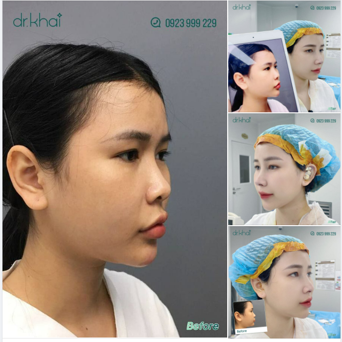 MŨI HẾCH - DÁNG MŨI KHÔNG ĐẸP TRONG PHONG THỦY NÂNG MŨI CẤU TRÚC - MŨI ĐẸP TẠO VẬN MAY