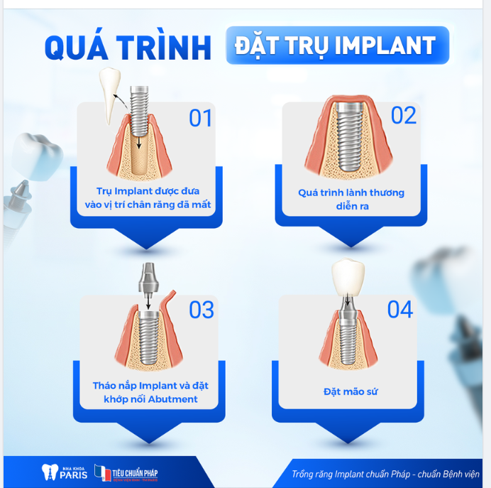 QUÁ TRÌNH ĐẶT TRỤ IMPLANT CHUẨN BỆNH VIỆN