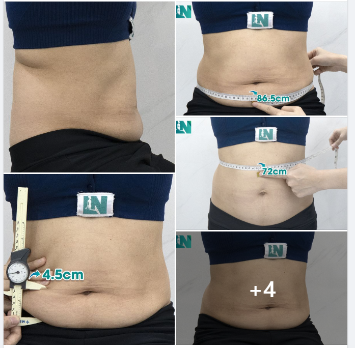  HÚT MỠ TẠO DÁNG THẨM MỸ  BỤNG KẾT HỢP TAY, LƯNG, NÁCH CHO CHỊ KH 7X, LỰA CHỌN GIẢM MỠ AN TOÀN. 
