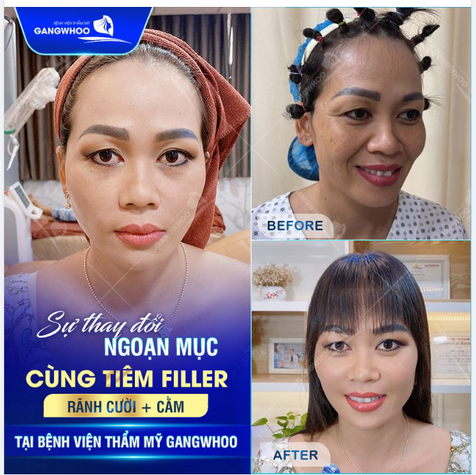 SỰ THAY ĐỔI NGOẠN MỤC CÙNG TIÊM FILLER RÃNH CƯỜI + CẰM TẠI BỆNH VIỆN THẨM MỸ GANGWHOO