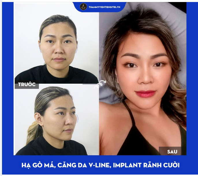THU NHỎ GƯƠNG MẶT BẰNG COMBO: HẠ GÒ MÁ, CĂNG DA VLINE IMPLANT RÃNH CƯỜI