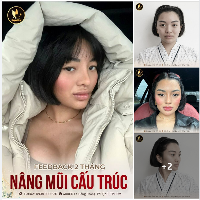 FEEDBACK 2 THÁNG NÂNG MŨI CẤU TRÚC
