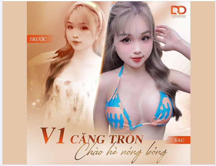 CHÀO HÈ TỰ TIN VỚI V1 CĂNG TRÒN, "BỎNG MẮT"