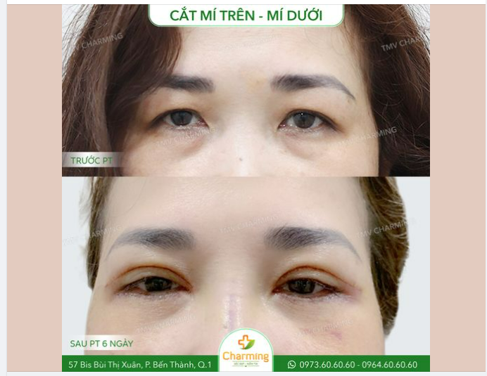 Cứ nói đến phẫu thuật cắt mí thì hầu hết mọi người đều mặc định nó là phẫu thuật cắt mí trên để tạo mắt hai mí, xử lý da chùng, mỡ thừa,... nhưng thật ra cắt mí còn có cả cắt mí dưới để lấy mỡ thừa bọng mắt và da chùng mí dưới nữa.