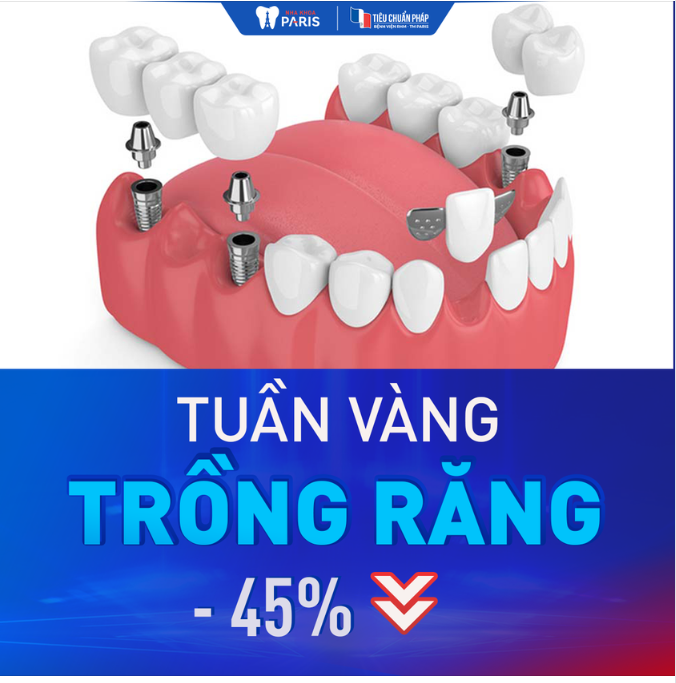 TUẦN VÀNG TRỒNG RĂNG - 45%