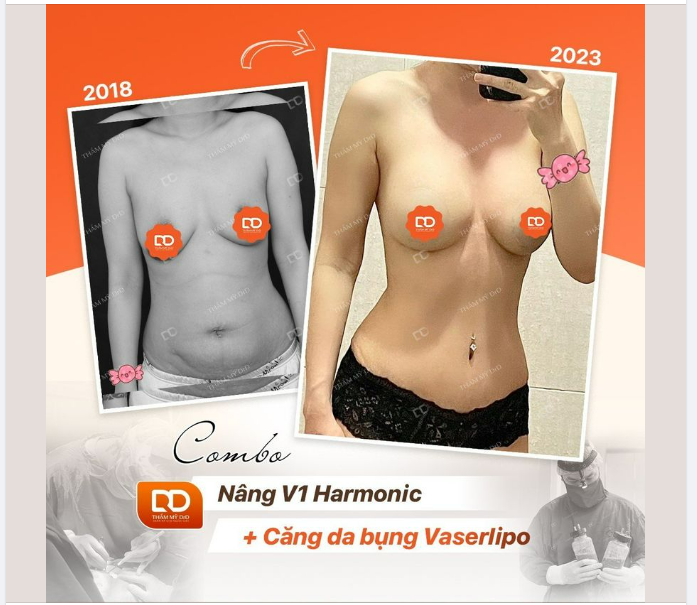COMBO NÂNG NGỰC + HÚT MỠ SAU 4 NĂM THỰC HIỆN PHẪU THUẬT