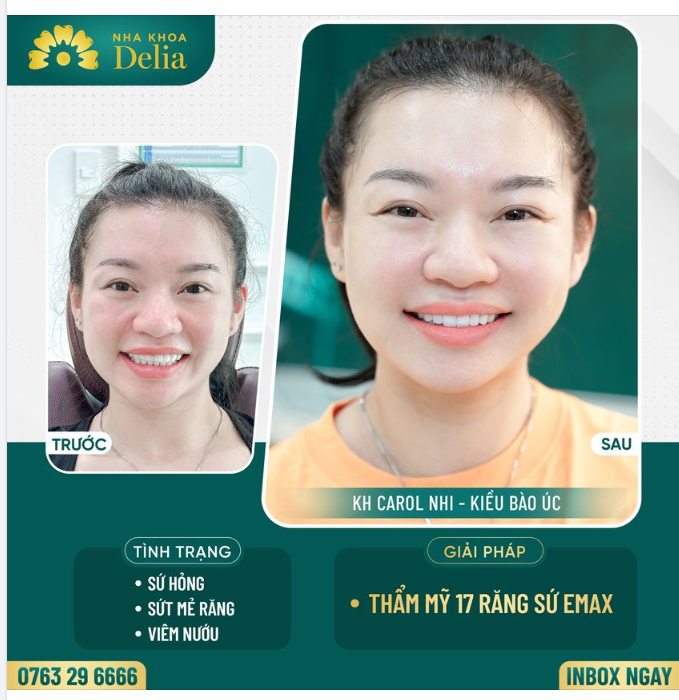 Xử lý răng sứ hỏng, sứt mẻ cho kiều bào Úc