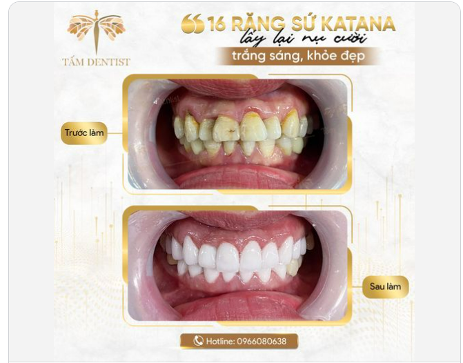 Lấy lại nụ cười trắng sáng, chắc khoẻ với 16 răng sứ Katana