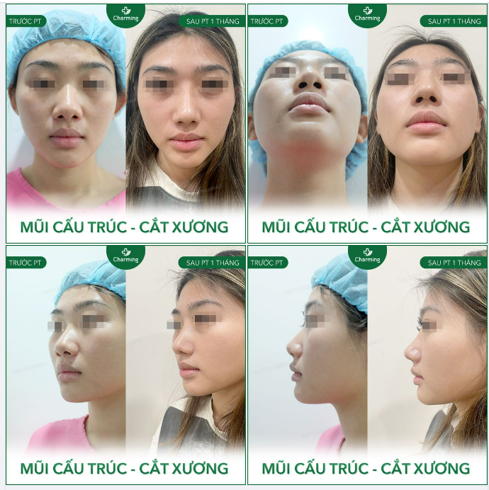 Bác sĩ ơi sao mũi em cao mà vẫn không đẹp?