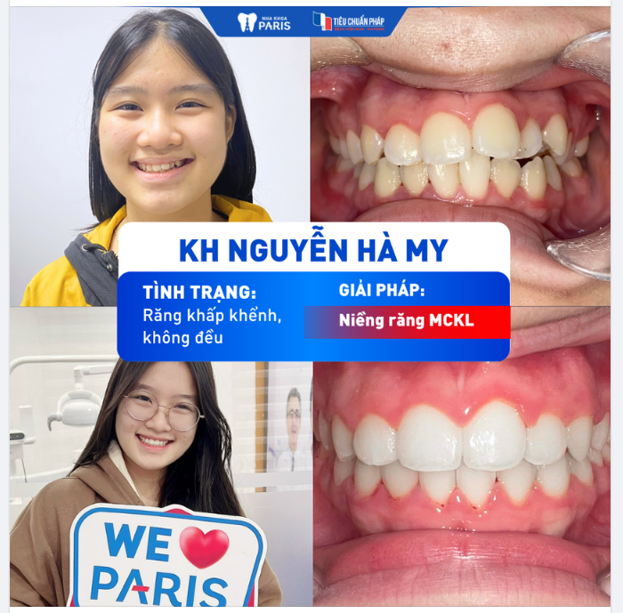NIỀNG RĂNG ĐỂ TỰ TIN VỚI NỤ CƯỜI RẠNG RỠ - EM NGUYỄN HÀ MY