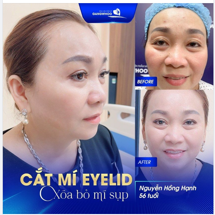 Chị Hồng Hạnh (56 tuổi) gặp tình trạng sụp mí mắt do lão hóa. Da mí mắt chùng nhão cùng với đó nếp nhăn khóe mắt khiến chị trông già hơn tuổi thật.