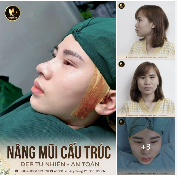 CẬN CẢNH KẾT QUẢ CA NÂNG MŨI CẤU TRÚC SAU 60 PHÚT CỦA EKIP BÁC SĨ HOẠT