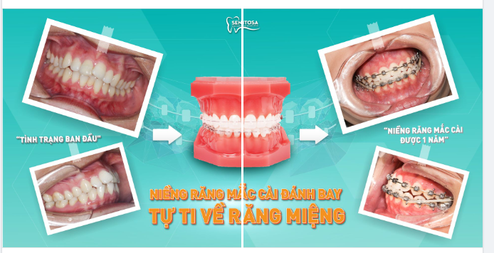 LÝ DO NÀO ĐỂ BẠN ĐƯA RA QUYẾT ĐỊNH NIỀNG RĂNG MẮC CÀI?