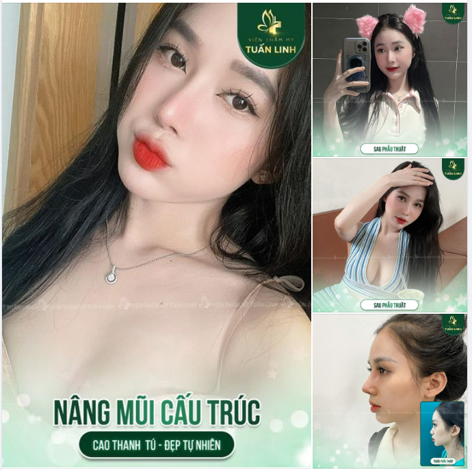 '' Trước đây mũi đã không đẹp lại còn bị gồ nữa, giờ mũi cao thẳng để mặt mộc thôi cũng thấy tự tin rồi…” - Chia sẻ siêu đáng yêu của khách hàng nhà Tuấn Linh sau nâng mũi.
