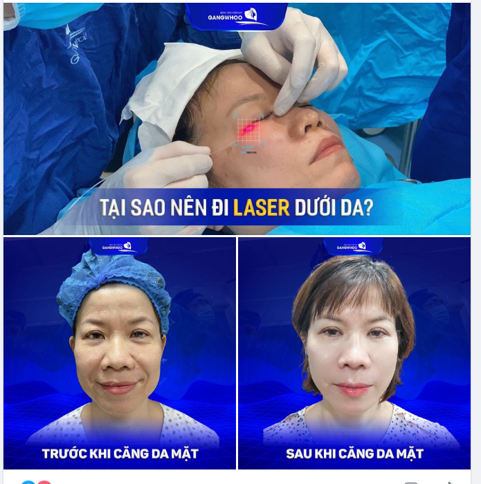 Cùng xem và đánh giá kết quả của một khách hàng tại Bệnh viện Gangwhoo sau khi thực hiện căng da mặt bằng laser nhé.