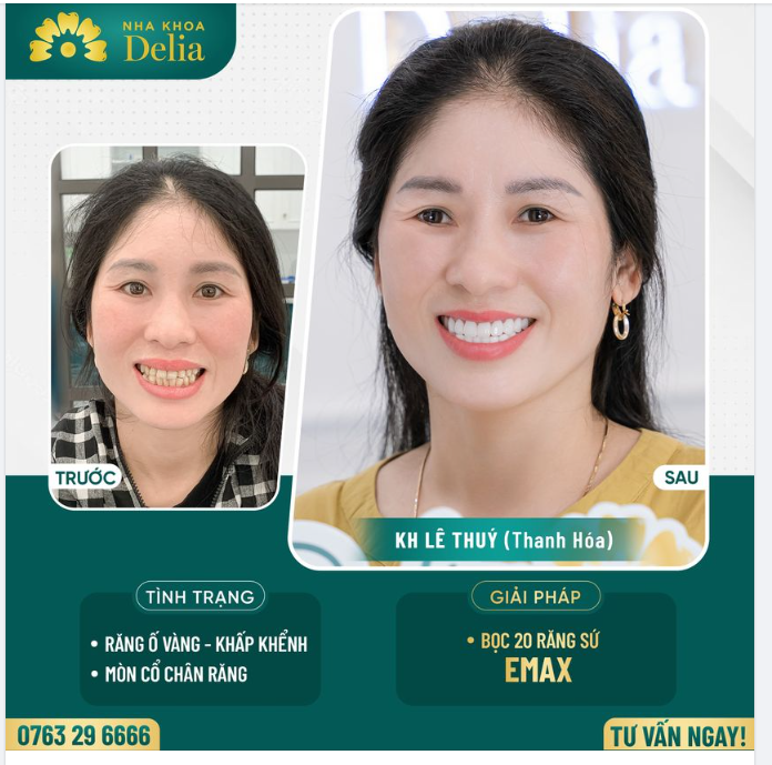 Thẩm mỹ 20 răng sứ Emax - Trọn vẹn nụ cười hanh phúc!