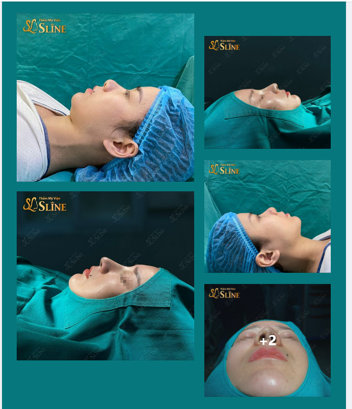 NÂNG MŨI CẤU TRÚC. Giảm ngay 30% - áp dụng khi thực hiện combo 2 dịch vụ làm đẹp.