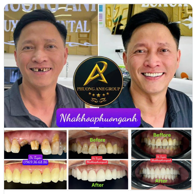 Hình ảnh bệnh nhân trước và sau điều trị làm đẹp tại Phuong Anh Group