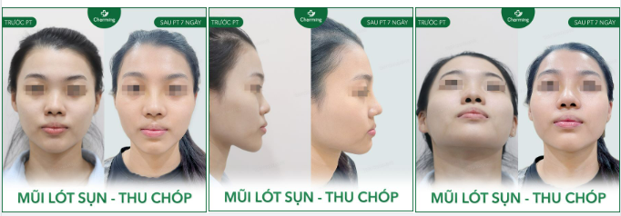 Không phải lúc nào mũi thô cũng do xương nền mũi cả. Có đôi lúc chóp mũi dù không quá to nhưng thật ra lại là nguyên nhân khiến phần mũi trông thô hơn.