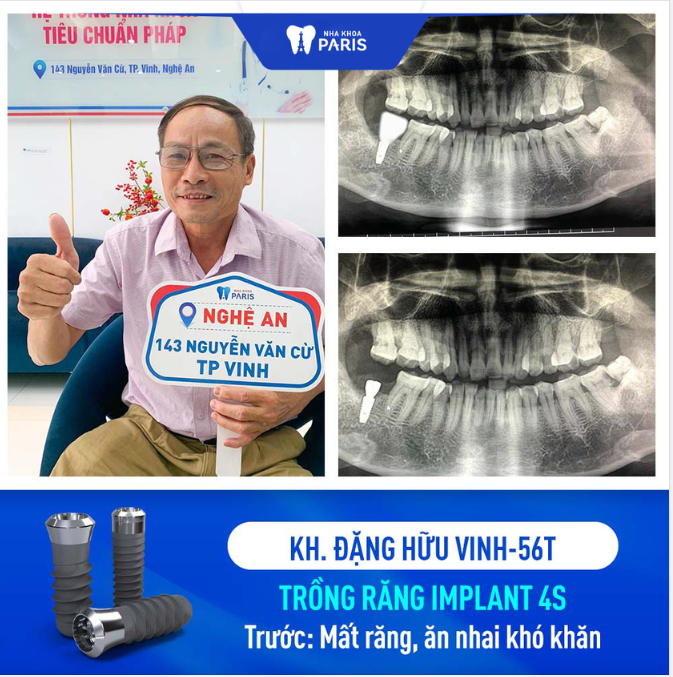 KH NGUYỄN HỮU VINH TRỒNG RĂNG IMPLANT 4S