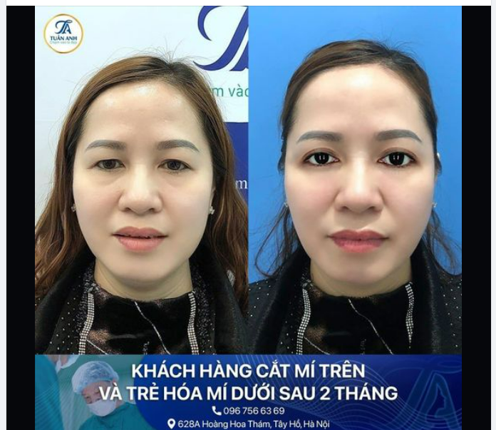 COMBO CẮT MÍ TRÊN TRẺ HOÁ MÍ DƯỚI