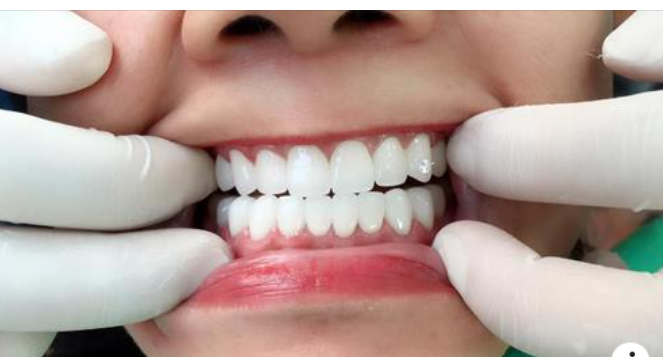 Các Vấn Đề Thường Gặp Sau Khi Trồng Răng Sứ Và Cách Khắc Phục