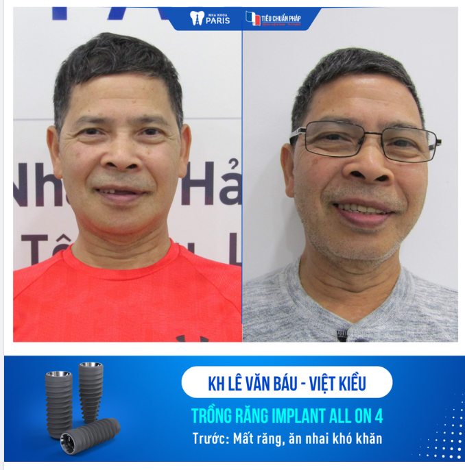 CHÚ LÊ VĂN BÁU - VIỆT KIỀU CANADA TRỒNG RĂNG IMPLANT ALL ON 4