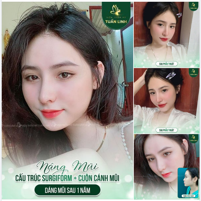 Không phải tự nhiên mà NÂNG MŨI TẠI TUẤN LINH lại được đông đảo anh chị em tin tưởng lựa chọn đến vậy. Dáng mũi luôn mang nét tự nhiên nhưng cũng rất sắc nét và đảm bảo hợp phong thủy