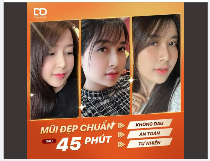 MŨI ĐẸP CHUẨN CHỈ SAU 45 PHÚT THỰC HIỆN