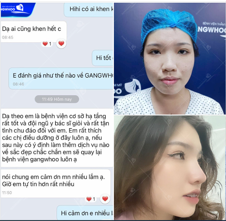 Là kết quả sau khi nâng mũi tại Bệnh viện thẩm mỹ Gangwhoo. Bạn khách hàng cũng hài lòng với vẻ ngoài xinh đẹp này.