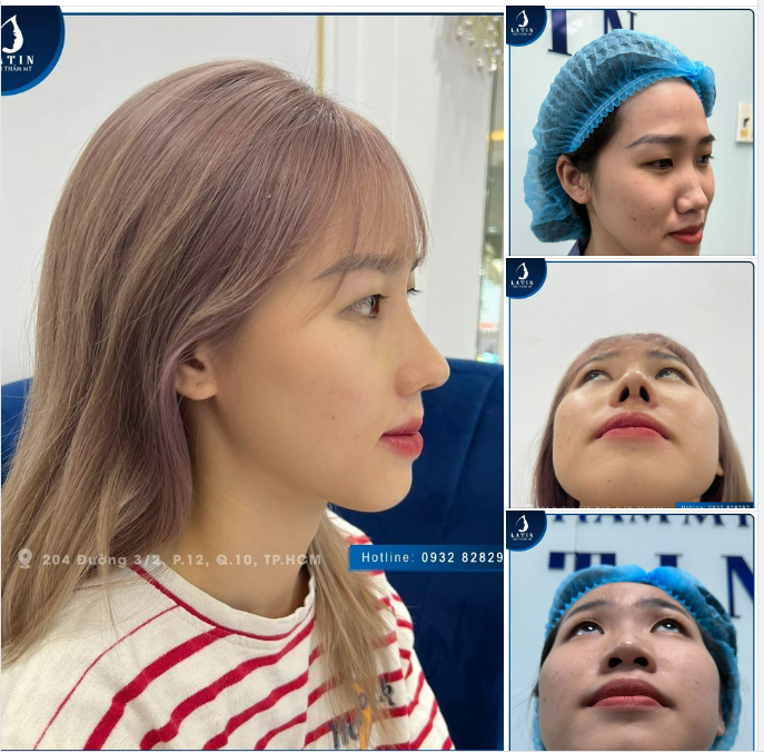 TÁI KHÁM MŨI CẤU TRÚC 1 THÁNG