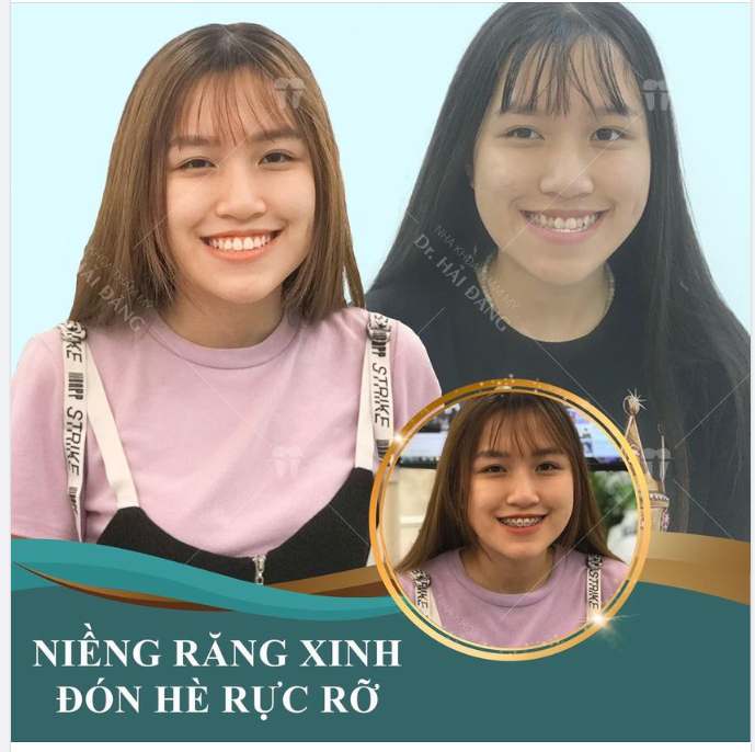 NIỀNG RĂNG HÔM NAY - NHẬN NGAY