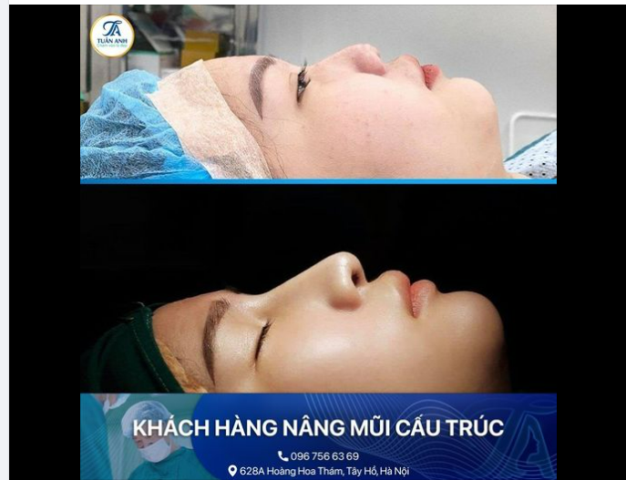 GIẢI CỨU MŨI TẸT THĂNG HẠNG NHAN SẮC TỰ TIN