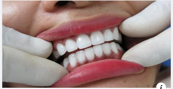 Cảm giác sau khi bọc răng sứ: Những điều bất thường cần lưu ý