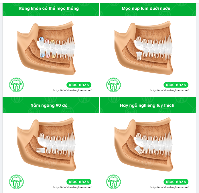 Răng khôn là chiếc răng mọc cuối cùng, nằm ở vị trí trong cùng của hàm.