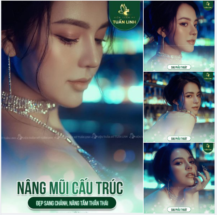 Nâng mũi cấu trúc - Đẹp sang cá tính - Nâng tầm thần thái đẹp ngút ngàn!!