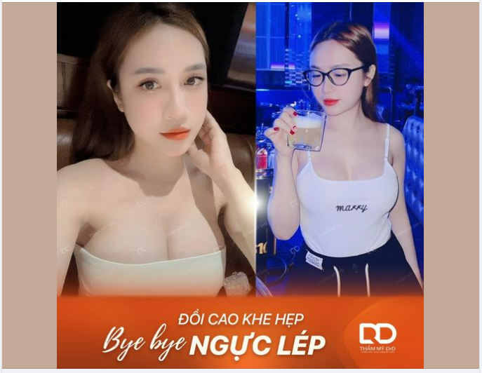 NÂNG V1 NỘI SOI HARMONIC: Không đau - Không sưng nề - Đảm bảo an toàn tối đa.