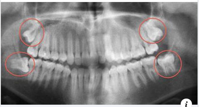 NHỮNG BIẾN CHỨNG DO RĂNG KHÔN MỌC LỆCH VÀ CÁCH XỬ TRÍ