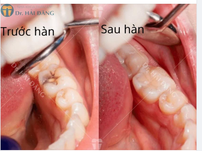 MỘT SỐ TRƯỜNG HỢP CẦN HÀN TRÁM RĂNG ?